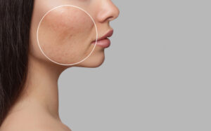 Hyperpigmentation Treatments